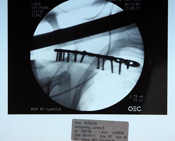 Lance Armstrong shoulder xray