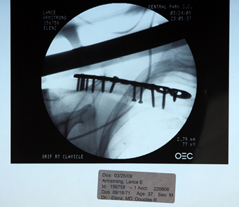 Lance Armstrong shoulder xray Lance Armstrong shoulder xray